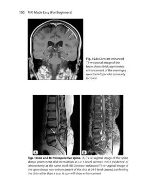100  MRI Made Easy (For Beginners)
Fig. 10.5: Contrast-enhanced
T1-w coronal image of the
brain shows thick asymmetric
enhancement of the meninges
over the left parietal convexity
(arrows)
Figs 10.6A and B: Postoperative spine. (A) T2-w sagittal image of the spine
shows prominent disk herniation at L4-5 level (arrow). Note evidence of
laminectomy at the same level. (B) Contrast-enhanced T1-w sagittal image of
the spine shows non-enhancement of the disk at L4-5 level (arrow), confirming
the disk rather than a scar. A scar will show enhancement
A B
Ch-10.indd 100 13-09-2012 16:05:49
 