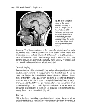 104  MRI Made Easy (For Beginners)
bright on T2-w images. Whatever the reason for scanning, a few basic
sequences need to be acquired in all brain examinations. Generally,
these sequences include T2-w axial, Diffusion, T1-w sagittal, gradient-
echo sequence to detect hemorrhage, T2-w FLAIR axial, and T2-w
coronal sequences. Examination usually starts with T2-w images and
can be tailored depending on what is seen on it.
Stroke Imaging
Examination should start with diffusion weighted images that will show
acute infarct. Gradient-echo sequence to detect acute bleed should be
donenextfollowedbyfastFLAIRthatshowssubarachnoidhemorrhage.
Time of flight MR angiography can be done to look for obstruction/
stenosis in the vessels. If infarcts are peripheral and hemorrhagic,
then phase contrast MR venograms are useful to rule out venous sinus
thrombosis (Fig. 11.2). In case of posterior circulation stroke, T1-w fat
saturated axial sections of the neck are acquired to look for vertebral
artery dissection or thrombosis (Fig. 11.3).
Tumors
MR is the best modality to evaluate brain tumors because of its
excellent soft tissue contrast and multiplanar capability. Intravenous
Fig. 11.1: T1-w sagittal
image of the brain.
Posterior pituitary is
seen as a bright spot in
the sella (arrow). Note
the bright homogenous
clivus (arrowhead) as it
contains fatty marrow.
Also appreciate the white
matter has higher signal
intensity than the gray
matter
Ch-11.indd 104 13-09-2012 16:07:21
 