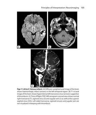 105 Principles of Interpretation: Neuroimaging
Figs 11.2A to C: Venous infarct. (A) Diffusion weighted axial image of the brain
shows haemorrhagic infarct (arrows) in the left temporal region. (B) T1-w axial
image of the brain shows hyperintense left transverse sinus (arrows) suggestive
of thrombosis. (C)Time of flight (TOF) MR venogram coronal view shows normal
right transverse (T), sigmoid sinus (S) and Jugular vein (J) as well as the superior
sagittal sinus (SSS). Left sided transverse, sigmoid sinuses and jugular vein are
not visualized in keeping with thrombosis
A B
C
Ch-11.indd 105 13-09-2012 16:07:21
 