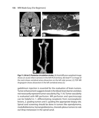 106  MRI Made Easy (For Beginners)
Figs11.3AtoC:Posteriorcirculationstroke.(A)Axialdiffusionweightedimage
shows an acute infarct (arrows) in the left PCA territory. (B) Axial T1-w image of
the neck shows vertebral artery dissection on the left side (arrow). (C) TOF MR
Angiogram shows dissection in the left vertebral artery (L)
gadolinium injection is essential for the evaluation of brain tumors.
Tumorenhancementsuggestsbreakintheblood-brainbarrieranddoes
not necessarily represent tumor vascularity (Fig. 11.4).Tumor vascularity
is evaluated with MR perfusion. MR perfusion and spectroscopy
can be helpful in: 1. differentiating neoplastic from nonneoplastic
lesions, 2. grading tumors and 3. guiding the appropriate biopsy site.
Spinal cord screening should be done in tumors like ependymoma,
medulloblastoma, hemangioblastoma, choroids plexus tumors to rule
out‘drop metastases’in the spinal canal.
A B
C
Ch-11.indd 106 13-09-2012 16:07:21
 