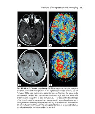 107 Principles of Interpretation: Neuroimaging
Figs 11.4A to D: Tumor vascularity. (A) T1-w postcontrast axial image of
the brain shows enhancing tumor in the right occipital lobe (arrows). (B) MR
Perfusion CCBV map (in the same patient shown in A) shows the lesion to be
hypovascular (arrows). Red color corresponds with high perfusion while blue
or dark color is suggestive of least perfusion. (C) T1-w postcontrast axial image
of the brain in another patient shows predominantly non-enhancing tumor in
the right cerebral hemisphere (arrows) causing mass effect and midline shift.
(D) MR Perfusion CCBV map (in the same patient shown in C) shows the tumor
to be hypervascular (red area marked by arrows)
A
C
B
D
Ch-11.indd 107 13-09-2012 16:07:21
 