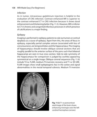 108  MRI Made Easy (For Beginners)
Infection
As in tumor, intravenous gadolinium injection is helpful in the
evaluation of CNS infection. Contrast enhanced MR is superior to
the contrast enhanced CT in CNS infection because it shows dural
enhancement and thickening better (Fig. 11.5). However, MR is inferior
to CT in chronic and congenital infectious processes in which presence
of calcifications is a major finding.
Epilepsy
Imaging is performed in epilepsy patients to rule out tumors or cortical
dysplasia as a cause of epilepsy. Apart from this, the areas of focus in
epilepsy, especially partial complex seizure (associated with loss of
consciousness), are temporal lobes and the hippocampus.The imaging
of hippocampus should involve oblique coronal sections that are
roughly parallel to the anterior surface of the pons such that bilateral
hippocampi are seen in true cross section. Side-to-side symmetry of
the hippocampus for comparison is judged by cochlea appearing
symmetrical on a single image. Oblique coronal sequences (Fig. 11.6)
include T2-w, FLAIR, medium TI inversion recovery and T1-w 3D GRE.
FLAIR images show small epileptogenic foci in the cortex and signal
abnormalities in the mesial temporal sclerosis. Medium TI inversion
Fig. 11.5: T1-w postcontrast
axial image of the brain shows
enhancing meninges over the left
cerebral hemisphere (arrows)
Ch-11.indd 108 13-09-2012 16:07:21
 