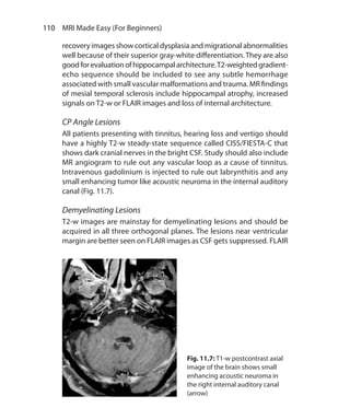110  MRI Made Easy (For Beginners)
recovery images show cortical dysplasia and migrational abnormalities
well because of their superior gray-white differentiation. They are also
goodforevaluationofhippocampalarchitecture.T2-weightedgradient-
echo sequence should be included to see any subtle hemorrhage
associated with small vascular malformations and trauma. MR findings
of mesial temporal sclerosis include hippocampal atrophy, increased
signals on T2-w or FLAIR images and loss of internal architecture.
CP Angle Lesions
All patients presenting with tinnitus, hearing loss and vertigo should
have a highly T2-w steady-state sequence called CISS/FIESTA-C that
shows dark cranial nerves in the bright CSF. Study should also include
MR angiogram to rule out any vascular loop as a cause of tinnitus.
Intravenous gadolinium is injected to rule out labrynthitis and any
small enhancing tumor like acoustic neuroma in the internal auditory
canal (Fig. 11.7).
Demyelinating Lesions
T2-w images are mainstay for demyelinating lesions and should be
acquired in all three orthogonal planes. The lesions near ventricular
margin are better seen on FLAIR images as CSF gets suppressed. FLAIR
Fig. 11.7: T1-w postcontrast axial
image of the brain shows small
enhancing acoustic neuroma in
the right internal auditory canal
(arrow)
Ch-11.indd 110 13-09-2012 16:07:21
 