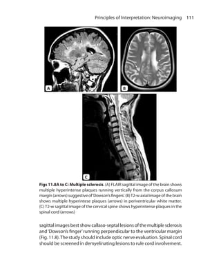 111 Principles of Interpretation: Neuroimaging
Figs 11.8A to C: Multiple sclerosis. (A) FLAIR sagittal image of the brain shows
multiple hyperintense plaques running vertically from the corpus callosum
margin (arrows) suggestive of‘Dowson’s fingers’. (B)T2-w axial image of the brain
shows multiple hyperintese plaques (arrows) in periventricular white matter.
(C) T2-w sagittal image of the cervical spine shows hyperintense plaques in the
spinal cord (arrows)
sagittal images best show callaso-septal lesions of the multiple sclerosis
and‘Dowson’s finger’running perpendicular to the ventricular margin
(Fig. 11.8).The study should include optic nerve evaluation. Spinal cord
should be screened in demyelinating lesions to rule cord involvement.
A B
C
Ch-11.indd 111 13-09-2012 16:07:22
 