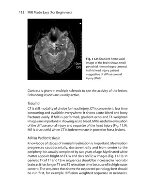 112  MRI Made Easy (For Beginners)
Contrast is given in multiple sclerosis to see the activity of the lesion.
Enhancing lesions are usually active.
Trauma
CT is still modality of choice for head injury. CT is convenient, less time
consuming and available everywhere. It shows acute bleed and bony
fractures easily. If MRI is performed, gradient-echo and T1-weighted
images are important in showing acute bleed. MR is useful in evaluation
of the diffuse axonal injury and sequelae of the head injury (Fig. 11.9).
MR is also useful when CT is indeterminate in posterior fossa lesions.
MRI in Pediatric Brain
Knowledge of stages of normal myelination is important. Myelination
progresses caudocranially, dorsoventrally and from center to the
periphery. It is usually completed by two years of age. Myelinated white
matter appears bright onT1-w and dark onT2-w images (Fig. 11.10). In
general, TR of T1 and T2-w sequences should be increased in neonatal
brain as it has longerT1 andT2 relaxation time because of its high water
content.The sequence that shows the suspected pathology best should
be run first, for example diffusion weighted sequence in neonates.
Fig. 11.9: Gradient hemo axial
image of the brain shows small
petechial hemorrhages (arrows)
in this head injury patient
suggestive of diffuse axonal
injury (DAI)
Ch-11.indd 112 13-09-2012 16:07:22
 