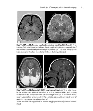 113 Principles of Interpretation: Neuroimaging
Figs 11.10A and B: Normal myelination in two months old infant. (A) T1-w
mediumTI IR axial image of the brain shows myelination in the posterior limb of
the internal capsule as bright linear signal (arrows). (B) T2-w axial image of the
brain shows myelination in posterior limbs as dark signal (arrow)
Figs 11.11A and B: Perinatal HIE/Hypoglycemic insult. (A) T2-w axial image
of the brain shows severe volume loss in occipito-parietal lobes with exvacio
dilatation of the lateral ventricles. (B) T1-w sagittal image of the brain shows
severe volume loss (arrowhead) in the occipital region with severe atrophy of
posterior part of corpus callosum (arrow)
These features are suggestive of perinatal hypoglycemic/hypoxic-ischaemic
insult
A B
A B
Ch-11.indd 113 13-09-2012 16:07:22
 