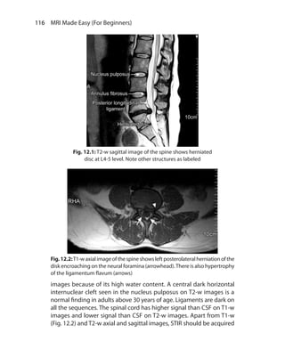 116  MRI Made Easy (For Beginners)
Fig.12.2:T1-waxialimageofthespineshowsleftposterolateralherniationofthe
disk encroaching on the neural foramina (arrowhead).There is also hypertrophy
of the ligamentum flavum (arrows)
images because of its high water content. A central dark horizontal
internuclear cleft seen in the nucleus pulposus on T2-w images is a
normal finding in adults above 30 years of age. Ligaments are dark on
all the sequences. The spinal cord has higher signal than CSF on T1-w
images and lower signal than CSF on T2-w images. Apart from T1-w
(Fig. 12.2) and T2-w axial and sagittal images, STIR should be acquired
Fig. 12.1: T2-w sagittal image of the spine shows herniated
disc at L4-5 level. Note other structures as labeled
Ch-12.indd 116 13-09-2012 16:08:43
 