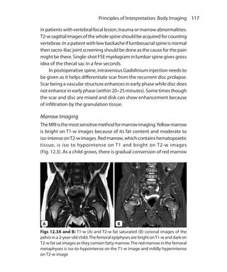 117 Principles of Interpretation: Body Imaging
in patients with vertebral focal lesion, trauma or marrow abnormalities.
T2-wsagittalimagesofthewholespineshouldbeacquiredforcounting
vertebrae. In a patient with low backache if lumbosacral spine is normal
then sacro-iliac joint screening should be done as the cause for the pain
might be there. Single-shot FSE myelogram in lumbar spine gives gross
idea of the thecal sac in a few seconds.
	 In postoperative spine, intravenous Gadolinium injection needs to
be given as it helps differentiate scar from the recurrent disc prolapse.
Scar being a vascular structure enhances in early phase while disc does
not enhance in early phase (within 20–25 minutes). Some times though
the scar and disc are mixed and disk can show enhancement because
of infiltration by the granulation tissue.
Marrow Imaging
TheMRIisthemostsensitivemethodformarrowimaging.Yellowmarrow
is bright on T1-w images because of its fat content and moderate to
iso-intense onT2-w images. Red marrow, which contains hematopoietic
tissue, is iso to hypointense on T1 and bright on T2-w images
(Fig. 12.3). As a child grows, there is gradual conversion of red marrow
Figs 12.3A and B: T1-w (A) and T2-w fat saturated (B) coronal images of the
pelvis in a 2-year-old child.The femoral epiphyses are bright onT1-w and dark on
T2-w fat sat images as they contain fatty marrow.The red marrow in the femoral
metaphyses is iso-to-hypointense on the T1-w image and mildly hyperintense
on T2-w image
A B
Ch-12.indd 117 13-09-2012 16:08:43
 