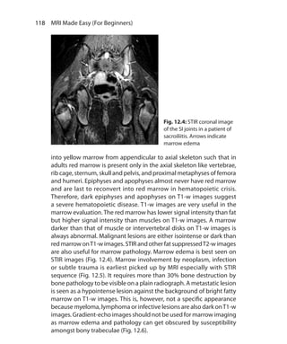 118  MRI Made Easy (For Beginners)
Fig. 12.4: STIR coronal image
of the SI joints in a patient of
sacroiliitis. Arrows indicate
marrow edema
into yellow marrow from appendicular to axial skeleton such that in
adults red marrow is present only in the axial skeleton like vertebrae,
rib cage, sternum, skull and pelvis, and proximal metaphyses of femora
and humeri. Epiphyses and apophyses almost never have red marrow
and are last to reconvert into red marrow in hematopoietic crisis.
Therefore, dark epiphyses and apophyses on T1-w images suggest
a severe hematopoietic disease. T1-w images are very useful in the
marrow evaluation. The red marrow has lower signal intensity than fat
but higher signal intensity than muscles on T1-w images. A marrow
darker than that of muscle or intervertebral disks on T1-w images is
always abnormal. Malignant lesions are either isointense or dark than
red marrow onT1-w images. STIR and other fat suppressedT2-w images
are also useful for marrow pathology. Marrow edema is best seen on
STIR images (Fig. 12.4). Marrow involvement by neoplasm, infection
or subtle trauma is earliest picked up by MRI especially with STIR
sequence (Fig. 12.5). It requires more than 30% bone destruction by
bone pathology to be visible on a plain radiograph. A metastatic lesion
is seen as a hypointense lesion against the background of bright fatty
marrow on T1-w images. This is, however, not a specific appearance
because myeloma, lymphoma or infective lesions are also dark onT1-w
images. Gradient-echo images should not be used for marrow imaging
as marrow edema and pathology can get obscured by susceptibility
amongst bony trabeculae (Fig. 12.6).
Ch-12.indd 118 13-09-2012 16:08:43
 