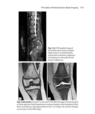 119 Principles of Interpretation: Body Imaging
Fig. 12.5: STIR sagittal image of
the lumbar spine shows multiple
bright spots in vertebral bodies
and posterior elements suggestive
of metastases in this patient with
known malignancy
Figs 12.6A and B: CoronalT1-w (A) andT2-FFE GRE (B) images of the knee joint
in a teen-age boy. Patchy hypointense marrow changes in the metaphysis of the
femur and tibia are only appreciated on the T1-w image. The marrow changes
are not seen on the GRE image
A B
Ch-12.indd 119 13-09-2012 16:08:43
 