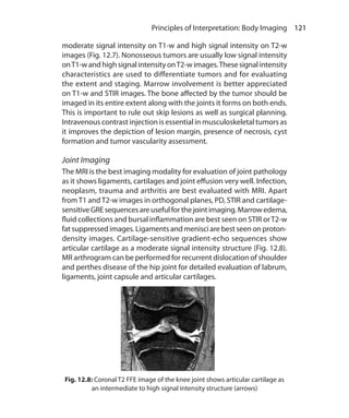 121 Principles of Interpretation: Body Imaging
moderate signal intensity on T1-w and high signal intensity on T2-w
images (Fig. 12.7). Nonosseous tumors are usually low signal intensity
onT1-w and high signal intensity onT2-w images.These signal intensity
characteristics are used to differentiate tumors and for evaluating
the extent and staging. Marrow involvement is better appreciated
on T1-w and STIR images. The bone affected by the tumor should be
imaged in its entire extent along with the joints it forms on both ends.
This is important to rule out skip lesions as well as surgical planning.
Intravenous contrast injection is essential in musculoskeletal tumors as
it improves the depiction of lesion margin, presence of necrosis, cyst
formation and tumor vascularity assessment.
Joint Imaging
The MRI is the best imaging modality for evaluation of joint pathology
as it shows ligaments, cartilages and joint effusion very well. Infection,
neoplasm, trauma and arthritis are best evaluated with MRI. Apart
fromT1 andT2-w images in orthogonal planes, PD, STIR and cartilage-
sensitiveGREsequencesareusefulforthejointimaging.Marrowedema,
fluid collections and bursal inflammation are best seen on STIR orT2-w
fat suppressed images. Ligaments and menisci are best seen on proton-
density images. Cartilage-sensitive gradient-echo sequences show
articular cartilage as a moderate signal intensity structure (Fig. 12.8).
MR arthrogram can be performed for recurrent dislocation of shoulder
and perthes disease of the hip joint for detailed evaluation of labrum,
ligaments, joint capsule and articular cartilages.
Fig. 12.8: Coronal T2 FFE image of the knee joint shows articular cartilage as
an intermediate to high signal intensity structure (arrows)
Ch-12.indd 121 13-09-2012 16:08:44
 