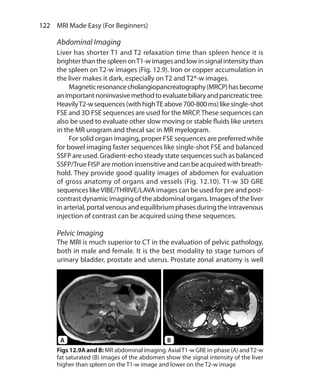 122  MRI Made Easy (For Beginners)
Abdominal Imaging
Liver has shorter T1 and T2 relaxation time than spleen hence it is
brighterthanthe spleenonT1-wimagesandlowinsignalintensitythan
the spleen on T2-w images (Fig. 12.9). Iron or copper accumulation in
the liver makes it dark, especially on T2 and T2*-w images.
	 Magneticresonancecholangiopancreatography(MRCP)hasbecome
animportantnoninvasivemethodtoevaluatebiliaryandpancreatictree.
HeavilyT2-wsequences(withhighTEabove700-800ms)likesingle-shot
FSE and 3D FSE sequences are used for the MRCP.These sequences can
also be used to evaluate other slow moving or stable fluids like ureters
in the MR urogram and thecal sac in MR myelogram.
	 For solid organ imaging, proper FSE sequences are preferred while
for bowel imaging faster sequences like single-shot FSE and balanced
SSFP are used. Gradient-echo steady state sequences such as balanced
SSFP/True FISP are motion insensitive and can be acquired with breath-
hold. They provide good quality images of abdomen for evaluation
of gross anatomy of organs and vessels (Fig. 12.10). T1-w 3D GRE
sequences likeVIBE/THRIVE/LAVA images can be used for pre and post-
contrast dynamic imaging of the abdominal organs. Images of the liver
in arterial, portal venous and equilibrium phases during the intravenous
injection of contrast can be acquired using these sequences.
Pelvic Imaging
The MRI is much superior to CT in the evaluation of pelvic pathology,
both in male and female. It is the best modality to stage tumors of
urinary bladder, prostate and uterus. Prostate zonal anatomy is well
Figs 12.9A and B: MR abdominal imaging. AxialT1-w GRE in-phase (A) andT2-w
fat saturated (B) images of the abdomen show the signal intensity of the liver
higher than spleen on the T1-w image and lower on the T2-w image
A B
Ch-12.indd 122 13-09-2012 16:08:44
 