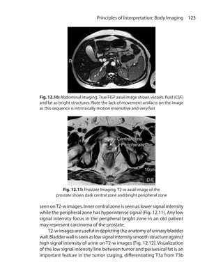 123 Principles of Interpretation: Body Imaging
Fig. 12.11: Prostate Imaging. T2-w axial image of the
prostate shows dark central zone and bright peripheral zone
seen onT2-w images. Inner central zone is seen as lower signal intensity
while the peripheral zone has hyperintense signal (Fig. 12.11). Any low
signal intensity focus in the peripheral bright zone in an old patient
may represent carcinoma of the prostate.
	 T2-w images are useful in depicting the anatomy of urinary bladder
wall.Bladderwallisseenaslowsignalintensitysmoothstructureagainst
high signal intensity of urine on T2-w images (Fig. 12.12). Visualization
of the low signal intensity line between tumor and perivesical fat is an
important feature in the tumor staging, differentiating T3a from T3b
Fig. 12.10: Abdominal imaging.True FISP axial image shows vessels, fluid (CSF)
and fat as bright structures. Note the lack of movement artifacts on the image
as this sequence is intrinsically motion insensitive and very fast
Ch-12.indd 123 13-09-2012 16:08:44
 