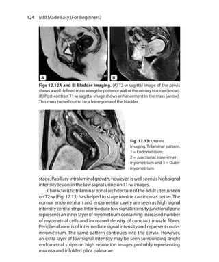 124  MRI Made Easy (For Beginners)
stage. Papillary intraluminal growth, however, is well seen as high signal
intensity lesion in the low signal urine on T1-w images.
	 Characteristic trilaminar zonal architecture of the adult uterus seen
onT2-w (Fig. 12.13) has helped to stage uterine carcinomas better.The
normal endometrium and endometrial cavity are seen as high signal
intensitycentralstripe.Intermediatelowsignalintensityjunctionalzone
represents an inner layer of myometrium containing increased number
of myometrial cells and increased density of compact muscle fibres.
Peripheral zone is of intermediate signal intensity and represents outer
myometrium. The same pattern continues into the cervix. However,
an extra layer of low signal intensity may be seen surrounding bright
endometrial stripe on high resolution images probably representing
mucosa and infolded plica palmatae.
Fig. 12.13: Uterine
Imaging. Trilaminar pattern.
1 = Endometrium;
2 = Junctional zone-inner
myometrium and 3 = Outer
myometrium
Figs 12.12A and B: Bladder Imaging. (A) T2-w sagittal image of the pelvis
showsawelldefinedmassalongtheposteriorwalloftheurinarybladder(arrow).
(B) Post-contrast T1-w sagittal image shows enhancement in the mass (arrow)
This mass turned out to be a leiomyoma of the bladder
A B
Ch-12.indd 124 13-09-2012 16:08:44
 