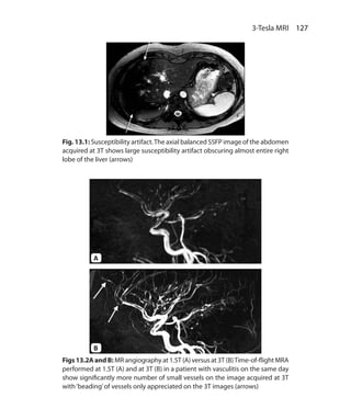 127 3-Tesla MRI
Fig. 13.1: Susceptibility artifact.The axial balanced SSFP image of the abdomen
acquired at 3T shows large susceptibility artifact obscuring almost entire right
lobe of the liver (arrows)
Figs13.2AandB: MR angiography at 1.5T (A) versus at 3T (B)Time-of-flight MRA
performed at 1.5T (A) and at 3T (B) in a patient with vasculitis on the same day
show significantly more number of small vessels on the image acquired at 3T
with‘beading’of vessels only appreciated on the 3T images (arrows)
A
B
Ch-13.indd 127 13-09-2012 16:12:42
 