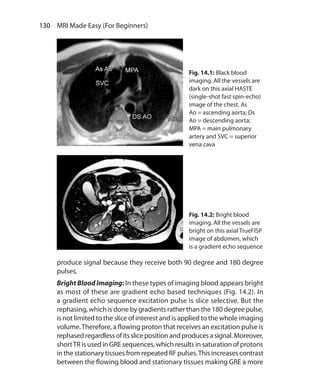 130  MRI Made Easy (For Beginners)
produce signal because they receive both 90 degree and 180 degree
pulses.
Bright Blood Imaging: In these types of imaging blood appears bright
as most of these are gradient echo based techniques (Fig. 14.2). In
a gradient echo sequence excitation pulse is slice selective. But the
rephasing, which is done by gradients rather than the 180 degree pulse,
is not limited to the slice of interest and is applied to the whole imaging
volume.Therefore, a flowing proton that receives an excitation pulse is
rephasedregardlessofitsslicepositionandproducesasignal.Moreover,
shortTR is used in GRE sequences, which results in saturation of protons
in the stationary tissues from repeated RF pulses.This increases contrast
between the flowing blood and stationary tissues making GRE a more
Fig. 14.1: Black blood
imaging. All the vessels are
dark on this axial HASTE
(single-shot fast spin-echo)
image of the chest. As
Ao = ascending aorta; Ds
Ao = descending aorta;
MPA = main pulmonary
artery and SVC = superior
vena cava
Fig. 14.2: Bright blood
imaging. All the vessels are
bright on this axial TrueFISP
image of abdomen, which
is a gradient echo sequence
Ch-14.indd 130 13-09-2012 16:13:45
 