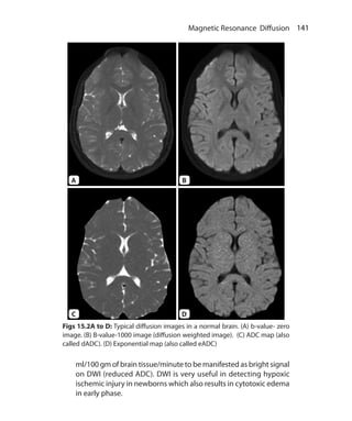 141 Magnetic Resonance Diffusion
ml/100 gm of brain tissue/minute to be manifested as bright signal
on DWI (reduced ADC). DWI is very useful in detecting hypoxic
ischemic injury in newborns which also results in cytotoxic edema
in early phase.
Figs 15.2A to D: Typical diffusion images in a normal brain. (A) b-value- zero
image. (B) B-value-1000 image (diffusion weighted image). (C) ADC map (also
called dADC). (D) Exponential map (also called eADC)
A
C
B
D
Ch-15.indd 141 13-09-2012 16:15:03
 