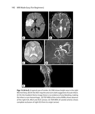 142  MRI Made Easy (For Beginners)
A B
DC
E
Figs 15.3A to E: A typical case of stroke. (A) DWI shows bright area in the right
MCA territory.(B) On the ADC map the area turns dark suggestive of acute infarct.
(C) On the Gradient Hemo image there is no evidence of any bleeding, making
the infarct a non-hemorrhagic. (D)TOF MRA of the circle ofWillis shows absence
of the right ICA, MCA and ACA (arrow). (E) TOR MRA of carotid arteries shows
complete occlusion of right ICA from its origin (arrow)
Ch-15.indd 142 13-09-2012 16:15:03
 