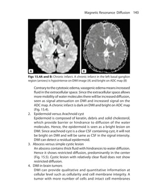 143 Magnetic Resonance Diffusion
	 Contrarytothecytotoxicedema,vasogenicedemameansincreased
fluid in the extracellular space. Since the extracellular space allows
more mobility of water molecules there will be increased diffusion,
seen as signal attenuation on DWI and increased signal on the
ADC map. A chronic infarct is dark on DWI and bright on ADC map
(Fig. 15.4).
2.	 Epidermoid versus Arachnoid cyst
	 Epidermoid is composed of keratin, debris and solid cholesterol,
which provide barrier or hindrance to diffusion of the water
molecules. Hence, the epidermoid is seen as a bright lesion on
DWI. Since arachnoid cyst is a clear CSF containing cyst, it will not
be bright on DWI and will be same as CSF in the signal intensity.
DWI can detect a residual epidermoid.
3. Abscess versus simple cystic lesion
	 An abscess contains thick fluid with hindrances to water diffusion.
Hence it shows restricted diffusion, predominantly in the center
(Fig. 15.5). Cystic lesion with relatively clear fluid does not show
restricted diffusion.
4. DWI in brain tumors
	 DWI can provide qualitative and quantitative information at
cellular level such as cellularity and cell membrane integrity. A
tumor with more number of cells and intact cell membranes
Figs 15.4A and B: Chronic infarct. A chronic infarct in the left basal ganglion
region (arrows) is hypointense on DWI image (A) and bright on ADC map (B)
A B
Ch-15.indd 143 13-09-2012 16:15:03
 