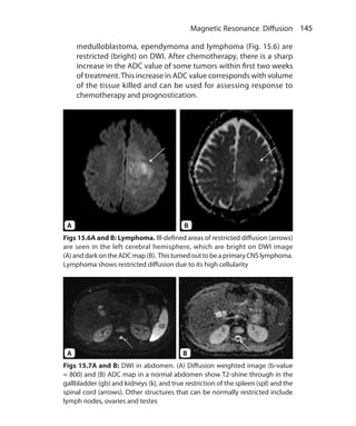 145 Magnetic Resonance Diffusion
Figs 15.6A and B: Lymphoma. Ill-defined areas of restricted diffusion (arrows)
are seen in the left cerebral hemisphere, which are bright on DWI image
(A)anddark ontheADC map(B). Thisturnedouttobeaprimary CNSlymphoma.
Lymphoma shows restricted diffusion due to its high cellularity
Figs 15.7A and B: DWI in abdomen. (A) Diffusion weighted image (b-value
= 800) and (B) ADC map in a normal abdomen show T2-shine through in the
gallbladder (gb) and kidneys (k), and true restriction of the spleen (spl) and the
spinal cord (arrows). Other structures that can be normally restricted include
lymph nodes, ovaries and testes
medulloblastoma, ependymoma and lymphoma (Fig. 15.6) are
restricted (bright) on DWI. After chemotherapy, there is a sharp
increase in the ADC value of some tumors within first two weeks
of treatment.This increase in ADC value corresponds with volume
of the tissue killed and can be used for assessing response to
chemotherapy and prognostication.
A
A
B
B
Ch-15.indd 145 13-09-2012 16:15:03
 