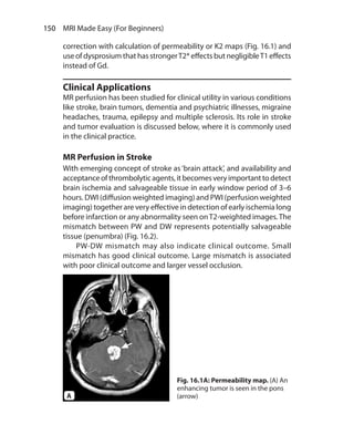 150  MRI Made Easy (For Beginners)
correction with calculation of permeability or K2 maps (Fig. 16.1) and
use of dysprosium that has strongerT2* effects but negligibleT1 effects
instead of Gd.
Clinical Applications
MR perfusion has been studied for clinical utility in various conditions
like stroke, brain tumors, dementia and psychiatric illnesses, migraine
headaches, trauma, epilepsy and multiple sclerosis. Its role in stroke
and tumor evaluation is discussed below, where it is commonly used
in the clinical practice.
MR Perfusion in Stroke
With emerging concept of stroke as ‘brain attack’, and availability and
acceptanceofthrombolyticagents,itbecomesveryimportanttodetect
brain ischemia and salvageable tissue in early window period of 3–6
hours. DWI (diffusion weighted imaging) and PWI (perfusion weighted
imaging) together are very effective in detection of early ischemia long
before infarction or any abnormality seen onT2-weighted images.The
mismatch between PW and DW represents potentially salvageable
tissue (penumbra) (Fig. 16.2).
	 PW-DW mismatch may also indicate clinical outcome. Small
mismatch has good clinical outcome. Large mismatch is associated
with poor clinical outcome and larger vessel occlusion.
Fig. 16.1A: Permeability map. (A) An
enhancing tumor is seen in the pons
(arrow)A
Ch-16.indd 150 13-09-2012 16:15:55
 