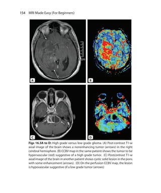 154  MRI Made Easy (For Beginners)
Figs 16.3A to D: High grade versus low grade glioma. (A) Post-contrast T1-w
axial image of the brain shows a nonenhancing tumor (arrows) in the right
cerebral hemisphere. (B) CCBV map in the same patient shows the tumor to be
hypervascular (red) suggestive of a high grade tumor. (C) Postcontrast T1-w
axial image of the brain in another patient shows cystic solid lesion in the pons
with some enhancement (arrows). (D) On the perfusion CCBV map, the lesion
is hypovascular suggestive of a low grade tumor (arrows)
A
C
B
D
Ch-16.indd 154 13-09-2012 16:15:56
 