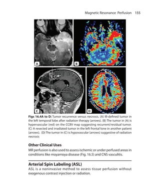 155 Magnetic Resonance Perfusion
Figs 16.4A to D: Tumor recurrence versus necrosis. (A) Ill-defined tumor in
the left temporal lobe after radiation therapy (arrows). (B) The tumor in (A) is
hypervascular (red) on the CCBV map suggesting recurrent/residual tumor.
(C) A resected and irradiated tumor in the left frontal lone in another patient
(arrows). (D) The tumor in (C) is hypovascular (arrows) suggestive of radiation
necrosis
Other Clinical Uses
MR perfusion is also used to assess ischemic or under perfused areas in
conditions like moyamoya disease (Fig. 16.5) and CNS vasculitis.
Arterial Spin Labeling (ASL)
ASL is a noninvasive method to assess tissue perfusion without
exogenous contrast injection or radiation.
A B
DC
Ch-16.indd 155 13-09-2012 16:15:56
 
