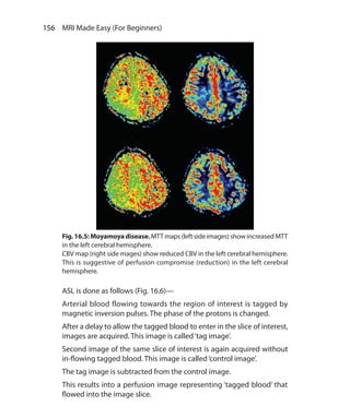 156  MRI Made Easy (For Beginners)
ASL is done as follows (Fig. 16.6)—
Arterial blood flowing towards the region of interest is tagged by
magnetic inversion pulses. The phase of the protons is changed.
After a delay to allow the tagged blood to enter in the slice of interest,
images are acquired. This image is called‘tag image’.
Second image of the same slice of interest is again acquired without
in-flowing tagged blood. This image is called‘control image’.
The tag image is subtracted from the control image.
This results into a perfusion image representing ‘tagged blood’ that
flowed into the image slice.
Fig.16.5: Moyamoyadisease. MTT maps (left side images) show increased MTT
in the left cerebral hemisphere.
CBV map (right side mages) show reduced CBV in the left cerebral hemisphere.
This is suggestive of perfusion compromise (reduction) in the left cerebral
hemisphere.
Ch-16.indd 156 13-09-2012 16:15:56
 