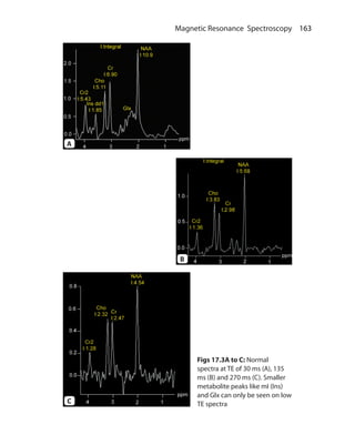 163 Magnetic Resonance Spectroscopy
Figs 17.3A to C: Normal
spectra at TE of 30 ms (A), 135
ms (B) and 270 ms (C). Smaller
metabolite peaks like mI (Ins)
and Glx can only be seen on low
TE spectra
A
B
C
Ch-17.indd 163 13-09-2012 16:17:22
 