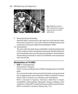 164  MRI Made Easy (For Beginners)
9.	 Data processing and display
	 Acquired data is processed to get spectrum and spectral maps.
Zero point of spectrum is set in the software itself by frequency of
a particular compound called Tetramethylsilane (TMS).
10.	 Interpretation
	 The area under the peak of any metabolite is directly proportional
to the number of spins contributing to the peak. Absolute values for
each metabolite may vary with age and population. Interpretation
should always be based on ratios of metabolites and comparison
with normal side.
Metabolites of 1H MRS
1.	 NAA: N- Acetylaspartate
	 Peak position: 2.02 ppm.
	 There is some contribution from NAAG and glutamate to the NAA
peak.
	 It is a neuronal marker and any insult to the brain causing neuronal
loss or degeneration causes reduction in NAA. It is absent in tissues/
lesions with no neurons e.g. metastasis and meningioma.
	 NAA is reduced in: hypoxia, infarction, Alzheimer’s, herpes
encephalitis, hydrocephalus, Alexander’s disease, epilepsy, some
neoplasms, stroke, NPH, closed head trauma (diffuse axonal injury).
	 NAA is increased in: Canavan’s disease (Fig. 17.5).
Fig. 17.4: Placement of
VOI. In Alzheimer’s disease
hippocampus is the VOI
(white box)
Ch-17.indd 164 13-09-2012 16:17:22
 