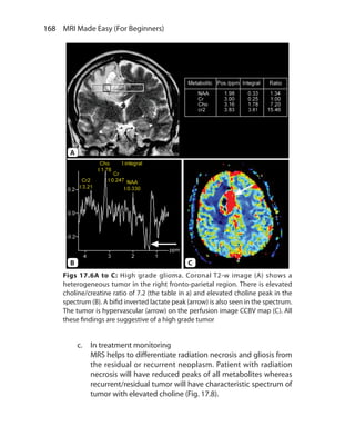 168  MRI Made Easy (For Beginners)
c.	 In treatment monitoring
	 MRS helps to differentiate radiation necrosis and gliosis from
the residual or recurrent neoplasm. Patient with radiation
necrosis will have reduced peaks of all metabolites whereas
recurrent/residual tumor will have characteristic spectrum of
tumor with elevated choline (Fig. 17.8).
Figs 17.6A to C: High grade glioma. Coronal T2-w image (A) shows a
heterogeneous tumor in the right fronto-parietal region. There is elevated
choline/creatine ratio of 7.2 (the table in a) and elevated choline peak in the
spectrum (B). A bifid inverted lactate peak (arrow) is also seen in the spectrum.
The tumor is hypervascular (arrow) on the perfusion image CCBV map (C). All
these findings are suggestive of a high grade tumor
A
B C
Ch-17.indd 168 13-09-2012 16:17:23
 