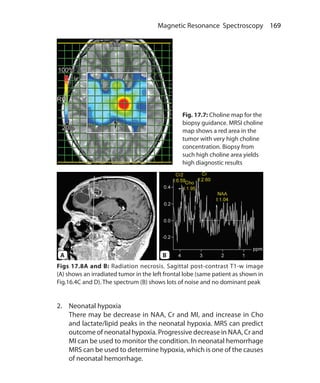 169 Magnetic Resonance Spectroscopy
Fig. 17.7: Choline map for the
biopsy guidance. MRSI choline
map shows a red area in the
tumor with very high choline
concentration. Biopsy from
such high choline area yields
high diagnostic results
Figs 17.8A and B: Radiation necrosis. Sagittal post-contrast T1-w image
(A) shows an irradiated tumor in the left frontal lobe (same patient as shown in
Fig.16.4C and D). The spectrum (B) shows lots of noise and no dominant peak
2.	 Neonatal hypoxia
	 There may be decrease in NAA, Cr and MI, and increase in Cho
and lactate/lipid peaks in the neonatal hypoxia. MRS can predict
outcome of neonatal hypoxia. Progressive decrease in NAA, Cr and
MI can be used to monitor the condition. In neonatal hemorrhage
MRS can be used to determine hypoxia, which is one of the causes
of neonatal hemorrhage.
A B
Ch-17.indd 169 13-09-2012 16:17:23
 