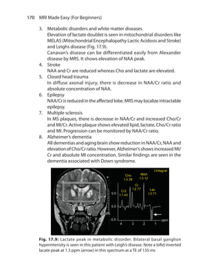 170  MRI Made Easy (For Beginners)
3.	 Metabolic disorders and white matter diseases
	 Elevation of lactate doublet is seen in mitochondrial disorders like
MELAS (Mitochondrial Encephalopathy Lactic Acidosis and Stroke)
and Leighs disease (Fig. 17.9).
	 Canavan’s disease can be differentiated easily from Alexander
disease by MRS. It shows elevation of NAA peak.
4.	 Stroke
	 NAA and Cr are reduced whereas Cho and lactate are elevated.
5.	 Closed head trauma
	 In diffuse axonal injury, there is decrease in NAA/Cr ratio and
absolute concentration of NAA.
6.	 Epilepsy
	 NAA/Cr is reduced in the affected lobe. MRS may localize intractable
epilepsy.
7.	 Multiple sclerosis
	 In MS plaques, there is decrease in NAA/Cr and increased Cho/Cr
and MI/Cr. Active plaque shows elevated lipid, lactate, Cho/Cr ratio
and MI. Progression can be monitored by NAA/Cr ratio.
8.	 Alzheimer’s dementia
	 All dementias and aging brain show reduction in NAA/Cr, NAA and
elevation of Cho/Cr ratio. However, Alzheimer’s shows increased MI/
Cr and absolute MI concentration. Similar findings are seen in the
dementia associated with Down syndrome.
Fig. 17.9: Lactate peak in metabolic disorder. Bilateral basal ganglion
hyperintensity is seen in this patient with Leigh’s disease. Note a bifid inverted
lacate peak at 1.3 ppm (arrow) in this spectrum at a TE of 135 ms
Ch-17.indd 170 13-09-2012 16:17:23
 