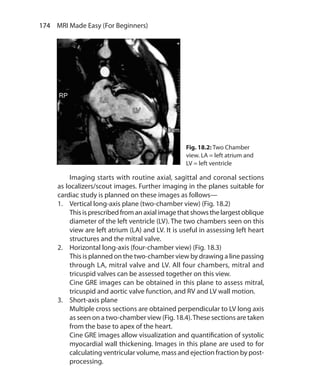 174  MRI Made Easy (For Beginners)
	 Imaging starts with routine axial, sagittal and coronal sections
as localizers/scout images. Further imaging in the planes suitable for
cardiac study is planned on these images as follows—
1.	 Vertical long-axis plane (two-chamber view) (Fig. 18.2)
	 Thisisprescribedfromanaxialimagethatshowsthelargestoblique
diameter of the left ventricle (LV). The two chambers seen on this
view are left atrium (LA) and LV. It is useful in assessing left heart
structures and the mitral valve.
2.	 Horizontal long-axis (four-chamber view) (Fig. 18.3)
	 This is planned on the two-chamber view by drawing a line passing
through LA, mitral valve and LV. All four chambers, mitral and
tricuspid valves can be assessed together on this view.
	 Cine GRE images can be obtained in this plane to assess mitral,
tricuspid and aortic valve function, and RV and LV wall motion.
3.	 Short-axis plane
	 Multiple cross sections are obtained perpendicular to LV long axis
as seen on a two-chamber view (Fig. 18.4).These sections are taken
from the base to apex of the heart.
	 Cine GRE images allow visualization and quantification of systolic
myocardial wall thickening. Images in this plane are used to for
calculating ventricular volume, mass and ejection fraction by post-
processing.
Fig. 18.2: Two Chamber
view. LA = left atrium and
LV = left ventricle
Ch-18.indd 174 13-09-2012 16:18:17
 