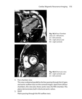 175 Cardiac Magnetic Resonance Imaging
Fig. 18.3: Four Chamber
view. LA = left atrium,
LV = left ventricle,
RA = right atrium and
RV = right ventricle
Fig. 18.4: Short axis view.
RV = right ventricle and
LV = left ventricle
4.	 Five-chamber view
	 ThisviewisobtainedparalleltothelinepassingthroughtheLVapex
and aortic outflow tract on the coronal images. Apart from all four
chambers, this view also shows aortic root, the fifth chamber. This
plane demonstrates both mitral and aortic valves.
5.	 RVOT
	 Plane passing through the RV outflow tract.
Ch-18.indd 175 13-09-2012 16:18:18
 