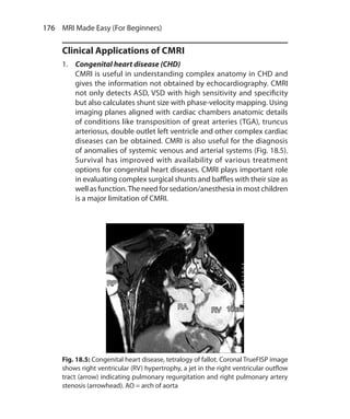 176  MRI Made Easy (For Beginners)
Clinical Applications of CMRI
1.	 Congenital heart disease (CHD)
	 CMRI is useful in understanding complex anatomy in CHD and
gives the information not obtained by echocardiography. CMRI
not only detects ASD, VSD with high sensitivity and specificity
but also calculates shunt size with phase-velocity mapping. Using
imaging planes aligned with cardiac chambers anatomic details
of conditions like transposition of great arteries (TGA), truncus
arteriosus, double outlet left ventricle and other complex cardiac
diseases can be obtained. CMRI is also useful for the diagnosis
of anomalies of systemic venous and arterial systems (Fig. 18.5).
Survival has improved with availability of various treatment
options for congenital heart diseases. CMRI plays important role
in evaluating complex surgical shunts and baffles with their size as
well as function.The need for sedation/anesthesia in most children
is a major limitation of CMRI.
Fig. 18.5: Congenital heart disease, tetralogy of fallot. Coronal TrueFISP image
shows right ventricular (RV) hypertrophy, a jet in the right ventricular outflow
tract (arrow) indicating pulmonary regurgitation and right pulmonary artery
stenosis (arrowhead). AO = arch of aorta
Ch-18.indd 176 13-09-2012 16:18:18
 