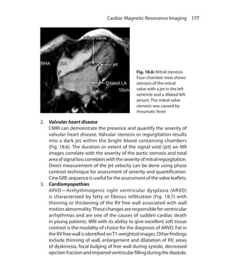 177 Cardiac Magnetic Resonance Imaging
2.	 Valvular heart disease
	 CMRI can demonstrate the presence and quantify the severity of
valvular heart disease. Valvular stenosis or regurgitation results
into a dark jet within the bright blood containing chambers
(Fig. 18.6). The duration or extent of the signal void (jet) on MR
images correlate with the severity of the aortic stenosis and total
areaofsignallosscorrelateswiththeseverityofmitralregurgitation.
Direct measurement of the jet velocity can be done using phase
contrast technique for assessment of severity and quantification.
Cine GRE sequence is useful for the assessment of the valve leaflets.
3.	 Cardiomyopathies
	ARVD—Arrhythmogenic right ventricular dysplasia (ARVD)
is characterized by fatty or fibrous infiltration (Fig. 18.7) with
thinning or thickening of the RV free wall associated with wall
motion abnormality.These changes are responsible for ventricular
arrhythmias and are one of the causes of sudden cardiac death
in young patients. MRI with its ability to give excellent soft tissue
contrast is the modality of choice for the diagnosis of ARVD. Fat in
the RV free wall is identified onT1-weighted images. Other findings
include thinning of wall, enlargement and dilatation of RV, areas
of dyskinesia, focal bulging of free wall during systole, decreased
ejection fraction and impaired ventricular filling during the diastole.
Fig. 18.6: Mitral stenosis.
Four-chamber view shows
stenosis of the mitral
valve with a jet in the left
ventricle and a dilated left
atrium. The mitral valve
stenosis was caused by
rheumatic fever
Ch-18.indd 177 13-09-2012 16:18:18
 