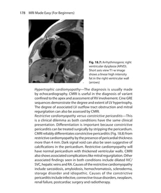 178  MRI Made Easy (For Beginners)
	 Hypertrophic cardiomyopathy—The diagnosis is usually made
by echocardiography. CMRI is useful in the diagnosis of variant
confined to the apex and assessment of RV involvement. Cine GRE
sequences demonstrate the degree and extent of LV hypertrophy.
The degree of associated LV outflow tract obstruction and mitral
regurgitation can also be assessed by CMRI.
	 Restrictive cardiomyopathy versus constrictive pericarditis—This
is a clinical dilemma as both conditions have the same clinical
presentation. Differentiation is important because constrictive
pericarditis can be treated surgically by stripping the pericardium.
CMRI reliably differentiates constrictive pericarditis (Fig. 18.8) from
restrictive cardiomyopathy by the presence of pericardial thickness
more than 4 mm. Dark signal void can also be seen suggestive of
calcifications in the pericardium. Restrictive cardiomyopathy will
have normal pericardium with thickened ventricular walls. CMRI
also shows associated complications like mitral regurgitation. Other
associated findings seen in both conditions include dilated IVC/
SVC, hepatic veins and RA. Causes of the restrictive cardiomyopathy
include sarcoidosis, amyloidosis, hemochromatosis, scleroderma,
storage disorder and idiopathic. Causes of the constrictive
pericarditisincludeinfective,connectivetissuedisorders,neoplasm,
renal failure, postcardiac surgery and radiotherapy.
Fig. 18.7: Arrhythmogenic right
ventricular dysplasia (ARVD).
Short axis view T1-w image
shows a linear high intensity
fat in the right ventricular wall
(arrows)
Ch-18.indd 178 13-09-2012 16:18:18
 