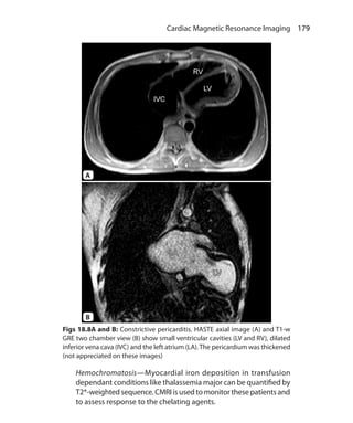 179 Cardiac Magnetic Resonance Imaging
Figs 18.8A and B: Constrictive pericarditis. HASTE axial image (A) and T1-w
GRE two chamber view (B) show small ventricular cavities (LV and RV), dilated
inferior vena cava (IVC) and the left atrium (LA).The pericardium was thickened
(not appreciated on these images)
	Hemochromatosis—Myocardial iron deposition in transfusion
dependant conditions like thalassemia major can be quantified by
T2*-weighted sequence. CMRIis used to monitorthesepatientsand
to assess response to the chelating agents.
A
B
Ch-18.indd 179 13-09-2012 16:18:18
 