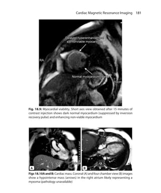181 Cardiac Magnetic Resonance Imaging
Figs 18.10A and B: Cardiac mass. Coronal (A) and four chamber view (B) images
show a hypointense mass (arrows) in the right atrium likely representing a
myxoma (pathology unavailable)
Fig. 18.9: Myocardial viability. Short axis view obtained after 15 minutes of
contrast injection shows dark normal myocardium (suppressed by inversion
recovery pulse) and enhancing non-viable myocardium
A B
Ch-18.indd 181 13-09-2012 16:18:18
 