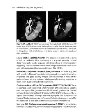 184  MRI Made Easy (For Beginners)
Single-shot FSE (SSFSE/HASTE): This sequence is acquired as slabs
of 2–5 cm thickness. Most commonly it is acquired as radial coronal
slabs.These slabs can be acquired with breath-hold or with respiratory
triggering.There is no need to MIP these images as the slabs show ducts
only with suppressed background tissues (Fig. 19.1B).
Balanced SSFP (TrueFISP/FIESTA/bTFE) sequence: It can be acquired
with breath-hold or with respiratory triggering. It is a motion insensitive
sequence and good quality images can be acquired in most of the
patients. It can serve a problem solving complementary sequence as
it can show ducts without motion artifacts.
Contrast-enhanced T1-w GRE sequences (THRIVE/VIBE/LAVA):These
sequences can be acquired after injection of hepatobiliary specific
contrast agents like gadobenate (Multihance), gadoxetate (Eovist/
primovist) and mangafodifir trisodium (Mn-DPDP, Teslascan). These
agents are excreted through bile opacifying the bile ducts on T1-w
images.This type of contrast-enhancedMRcholangiographyis useful for
the detection of bile leak and for visualization of smaller ducts.
Secretin MR Cholangiopancreatography (S-MRCP): Secretin is a
hormone secreted by duodenal mucosa in response to acid stimulation.
Figs 19.1A and B: 3D MRCP versus single-shot radial slab MRCP. Coronal MIP
image from 3D FSE sequence (A) and single-shot radial slab (B) show dilatation
of extrahepatic (arrowhead) as well as intrahepatic (short arrows) bile ducts
in this patient with choledochal cyst. Long arrow = pancreatic duct and
GB = gallbladder
A B
Ch-19.indd 184 13-09-2012 16:19:26
 