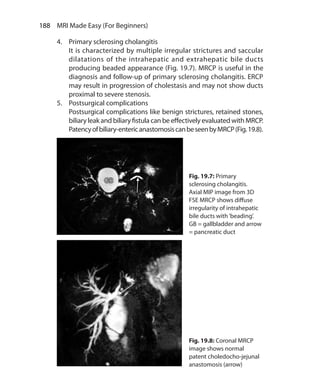 188  MRI Made Easy (For Beginners)
4.	 Primary sclerosing cholangitis
	 It is characterized by multiple irregular strictures and saccular
dilatations of the intrahepatic and extrahepatic bile ducts
producing beaded appearance (Fig. 19.7). MRCP is useful in the
diagnosis and follow-up of primary sclerosing cholangitis. ERCP
may result in progression of cholestasis and may not show ducts
proximal to severe stenosis.
5.	 Postsurgical complications
	 Postsurgical complications like benign strictures, retained stones,
biliary leak and biliary fistula can be effectively evaluated with MRCP.
Patencyofbiliary-entericanastomosiscanbeseenbyMRCP(Fig.19.8).
Fig. 19.7: Primary
sclerosing cholangitis.
Axial MIP image from 3D
FSE MRCP shows diffuse
irregularity of intrahepatic
bile ducts with‘beading’.
GB = gallbladder and arrow
= pancreatic duct
Fig. 19.8: Coronal MRCP
image shows normal
patent choledocho-jejunal
anastomosis (arrow)
Ch-19.indd 188 13-09-2012 16:19:26
 