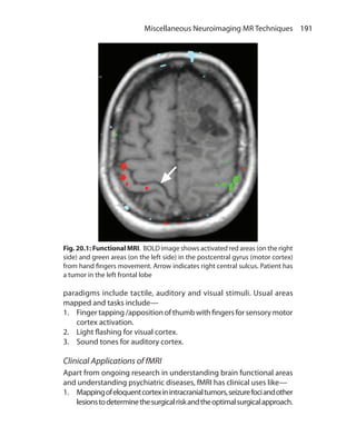 191 Miscellaneous Neuroimaging MR Techniques
paradigms include tactile, auditory and visual stimuli. Usual areas
mapped and tasks include—
1.	 Finger tapping /apposition of thumb with fingers for sensory motor
cortex activation.
2.	 Light flashing for visual cortex.
3.	 Sound tones for auditory cortex.
Clinical Applications of fMRI
Apart from ongoing research in understanding brain functional areas
and understanding psychiatric diseases, fMRI has clinical uses like—
1.	 Mappingofeloquentcortexinintracranialtumors,seizurefociandother
lesionstodeterminethesurgicalriskandtheoptimalsurgicalapproach.
Fig. 20.1: Functional MRI. BOLD image shows activated red areas (on the right
side) and green areas (on the left side) in the postcentral gyrus (motor cortex)
from hand fingers movement. Arrow indicates right central sulcus. Patient has
a tumor in the left frontal lobe
Ch-20.indd 191 13-09-2012 16:20:23
 