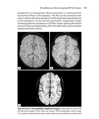 193 Miscellaneous Neuroimaging MR Techniques
Figs 20.2A to C: Susceptibility weighted imaging. Magnitude (A) and minIP
(B) SWI axial images of the brain are shown. SWI venography/ minIP image
(C) in another patient shows dark vessels with increase visibility of small vessels
prospective or retrospective. Most commonly, it is performed for
assessment of flow in the aqueduct. The flow can be assessed in two
ways: in-plane (along the aqueduct) and through-plane (perpendicular
to the aqueduct). At the end of examination, magnitude images
(showing anatomy) and phase or CSF flow images (giving information
aboutCSFflow)areobtained(Fig.20.3).Thedataisalsousedtocalculate
aqueductal stroke volume.
A
C
B
Ch-20.indd 193 13-09-2012 16:20:23
 