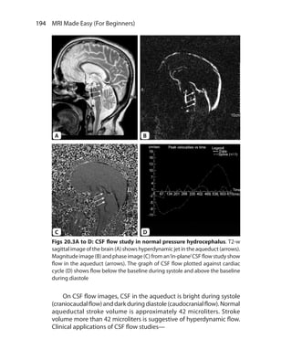 194  MRI Made Easy (For Beginners)
	 On CSF flow images, CSF in the aqueduct is bright during systole
(craniocaudalflow)anddarkduringdiastole(caudocranialflow).Normal
aqueductal stroke volume is approximately 42 microliters. Stroke
volume more than 42 microliters is suggestive of hyperdynamic flow.
Clinical applications of CSF flow studies—
Figs 20.3A to D: CSF flow study in normal pressure hydrocephalus. T2-w
sagittal image of the brain (A) shows hyperdynamic jet in the aqueduct (arrows).
Magnitude image (B) and phase image (C) from an‘in-plane’CSF flow study show
flow in the aqueduct (arrows). The graph of CSF flow plotted against cardiac
cycle (D) shows flow below the baseline during systole and above the baseline
during diastole
A B
DC
Ch-20.indd 194 13-09-2012 16:20:23
 