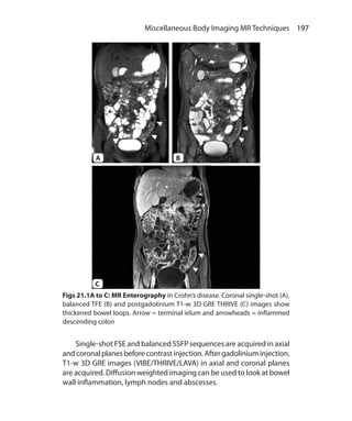 197 Miscellaneous Body Imaging MR Techniques
	 Single-shot FSE and balanced SSFP sequences are acquired in axial
andcoronalplanesbeforecontrastinjection.Aftergadoliniuminjection,
T1-w 3D GRE images (VIBE/THRIVE/LAVA) in axial and coronal planes
are acquired. Diffusion weighted imaging can be used to look at bowel
wall inflammation, lymph nodes and abscesses.
Figs 21.1A to C: MR Enterography in Crohn’s disease. Coronal single-shot (A),
balanced TFE (B) and postgadolinium T1-w 3D GRE THRIVE (C) images show
thickened bowel loops. Arrow = terminal ielum and arrowheads = inflammed
descending colon
A
C
B
Ch-21.indd 197 13-09-2012 16:21:02
 