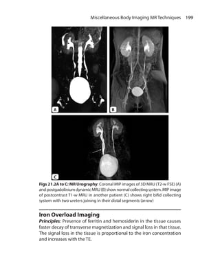199 Miscellaneous Body Imaging MR Techniques
Iron Overload Imaging
Principles: Presence of ferritin and hemosiderin in the tissue causes
faster decay of transverse magnetization and signal loss in that tissue.
The signal loss in the tissue is proportional to the iron concentration
and increases with the TE.
Figs 21.2A to C: MR Urography: Coronal MIP images of 3D MRU (T2-w FSE) (A)
andpostgadoliniumdynamicMRU(B)shownormalcollectingsystem.MIPimage
of postcontrast T1-w MRU in another patient (C) shows right bifid collecting
system with two ureters joining in their distal segments (arrow)
A
C
B
Ch-21.indd 199 13-09-2012 16:21:03
 