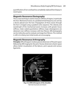 201 Miscellaneous Body Imaging MR Techniques
quantification of iron overload has completely replaced liver biopsy in
recent years.
Magnetic Resonance Elastography
This is a new technique used to measure stiffness of organs, in particular
the liver. Mechanical waves at a predetermined frequency are sent by
a device placed over the liver. Propagation of these waves through
the liver is imaged using a gradient-echo sequence. The velocity and
wavelength of the mechanical waves increases with greater tissue
stiffness. Color coded quantitative stiffness maps (elastograms) are
obtained. Liver stiffness increases with liver fibrosis. MR elastography
can be indirectly used to evaluate and stage liver fibrosis. This method
is still in its infancy but initial results are encouraging.
Magnetic Resonance Arthrography
Principles: MR arthrogram involves passive distension of the joint space
followed by MR imaging for the joint. Passive distension of joint space
allows better visualization of the labrum, joint capsule and various
ligaments.
Fig. 21.4: MR Arthrogram of the shoulder.
Normal structures are shown
Ch-21.indd 201 13-09-2012 16:21:03
 