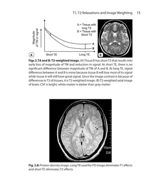 15 T1, T2 Relaxations and Image Weighting
Figs 2.7A and B: T2-weighted image. (A)Tissue B has shortT2 that results into
early loss of magnitude of TM and reduction in signal. At short TE, there is no
significant difference between magnitude of TM of A and B. At long TE, signal
difference between A and B is more because tissue B will lose most of its signal
while tissue A will still have good signal. Since the image contrast is because of
differences inT2 of tissues, it isT2-weighted image. (B)T2-weighted axial image
of brain: CSF is bright; white matter is darker than gray matter
Fig. 2.8: Proton-density image. LongTR used for PD image eliminatesT1 effects
and short TE eliminates T2 effects
BA
Ch-2.indd 15 13-09-2012 15:52:34
 