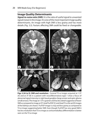 20  MRI Made Easy (For Beginners)
Image Quality Determinants
Signal-to-noise ratio (SNR): It is the ratio of useful signal to unwanted
signal (noise) in the image. It is one of the most important image quality
determinants. An image with high SNR is less grainy and has more
details (Fig. 3.3). Factors affecting SNR could be fixed or changeable.
Figs 3.3A to D: SNR and resolution. Coronal T2-w images acquired at 1.5T
(A) and at 3T (B) in a patient with neurofibromatosis type 1 show a focus of
abnormal signal intensity in right basal ganglion (large arrow) and optic glioma
(smallarrows).The imageat 1.5Tisgrainierandhaslessdetailsuggestiveoflower
SNRascomparedtoimageat3T.AxialTruFISP(C)andAxialT2-wfatsat(D)images
of the kidneys are shown.TruFISP image is crisp and less grainy as compared to
T2-w image suggesting better SNR. Even though TruFISP has very good SNR it
has less resolution thanT2-w image as corticomedullary differentiation is better
seen on the T2-w image
A
C
B
D
Ch-3.indd 20 13-09-2012 15:54:14
 